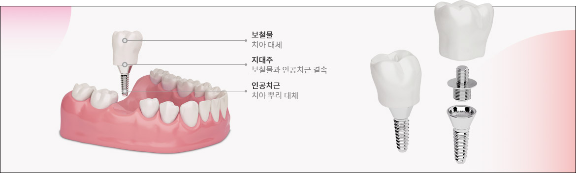 임플란트 관련 이미지